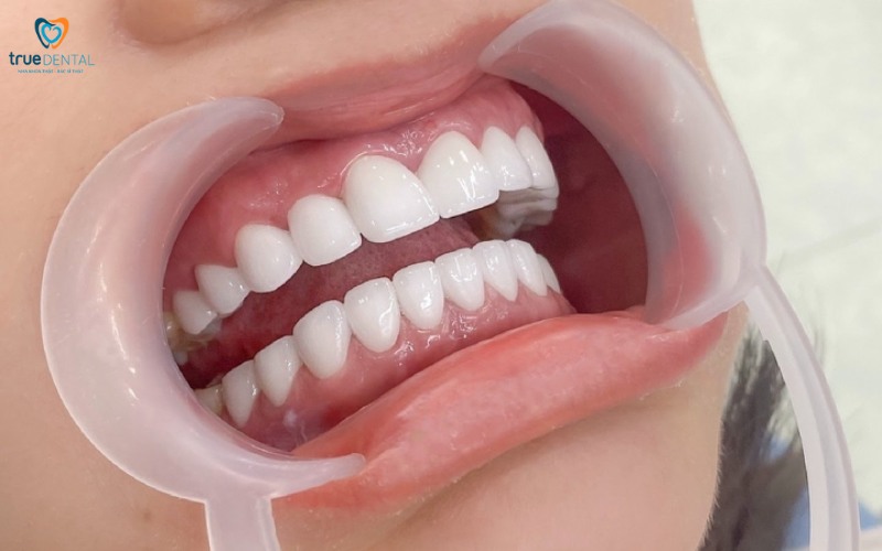 lợi ích bọc răng sứ so với niềng răng