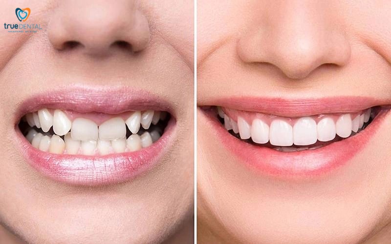 lợi ích bọc răng sứ so với niềng răng