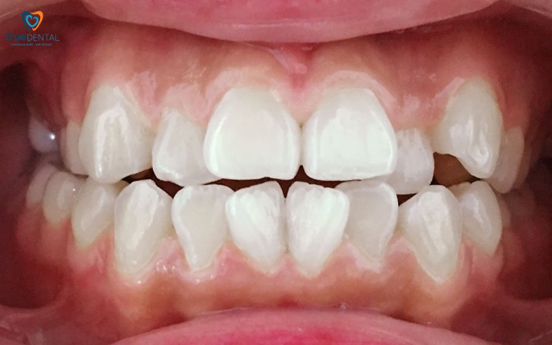lợi ích bọc răng sứ so với niềng răng