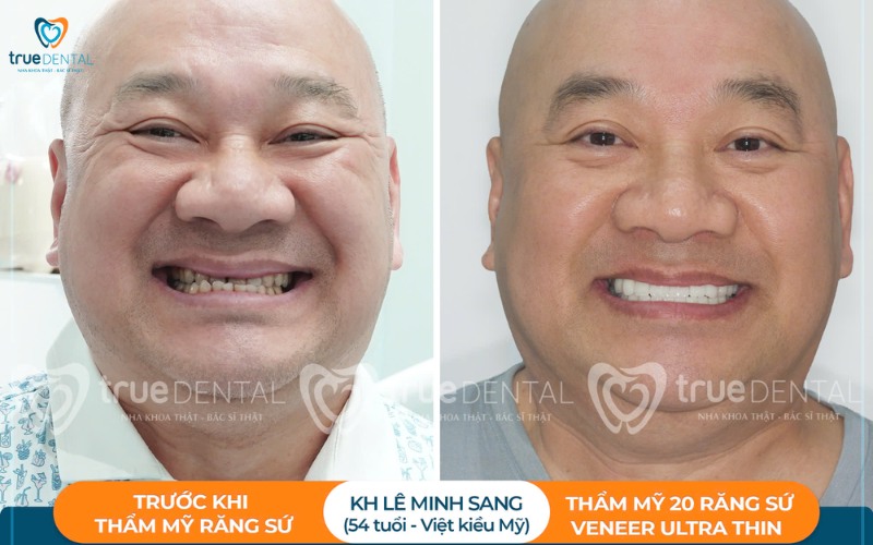 lợi ích bọc răng sứ so với niềng răng