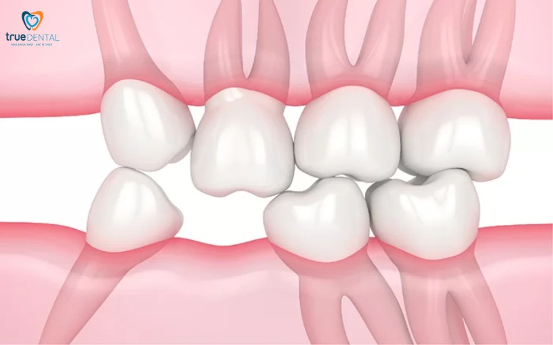 Lợi ích cấy ghép Implant so với hàm giả tháo lắp 1 Lợi ích cấy ghép Implant so với hàm giả tháo lắp