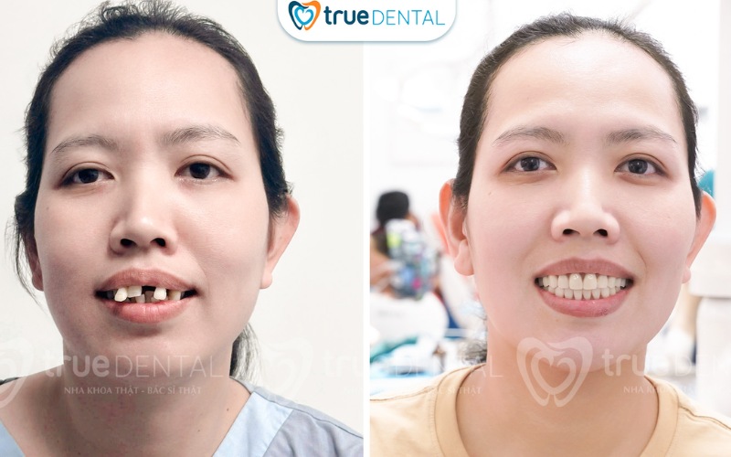 Lợi ích cấy ghép Implant so với hàm giả tháo lắp 4 Lợi ích cấy ghép Implant so với hàm giả tháo lắp