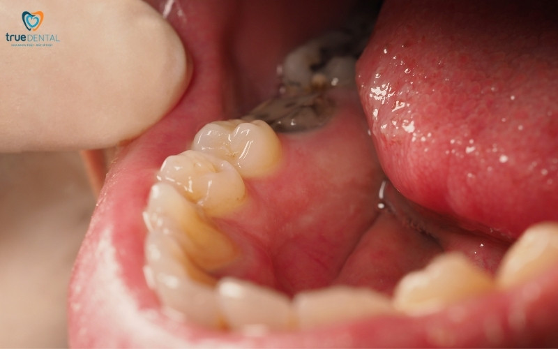 Lợi ích khám răng định kỳ hàng tháng cho sức khỏe 2 Lợi ích khám răng định kỳ hàng tháng