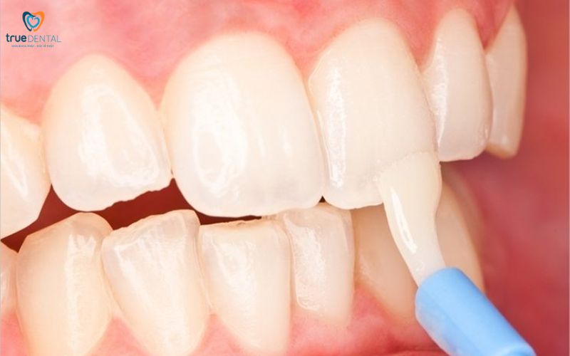 Lợi ích khám răng định kỳ hàng tháng cho sức khỏe 8 lợi ích khám răng định kỳ hàng tháng