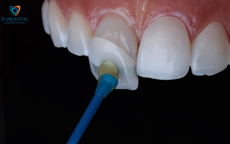 lợi ích niềng răng so với dán veneer thẩm mỹ