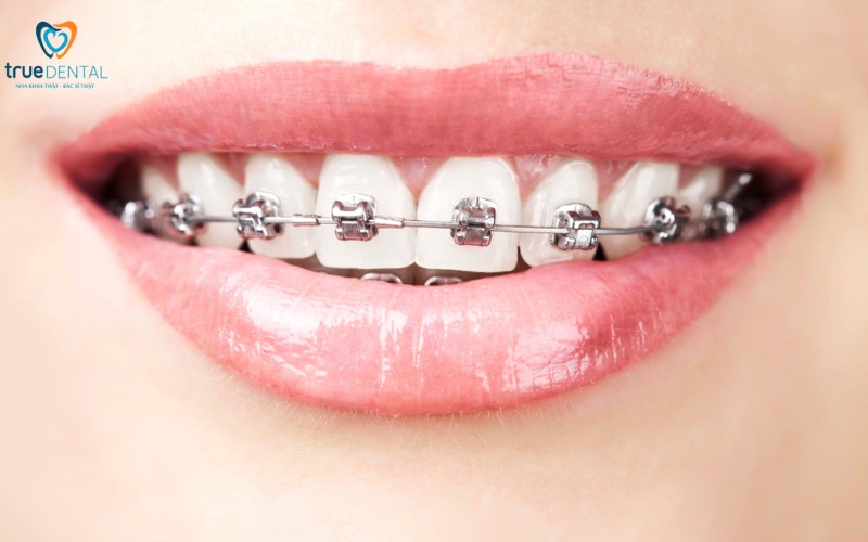 lợi ích niềng răng so với dán veneer thẩm mỹ