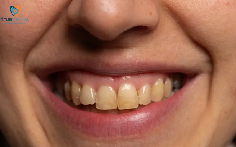 lợi ích niềng răng so với dán veneer thẩm mỹ