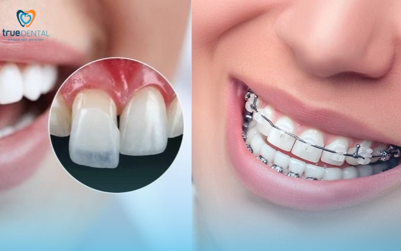 lợi ích niềng răng so với dán veneer thẩm mỹ