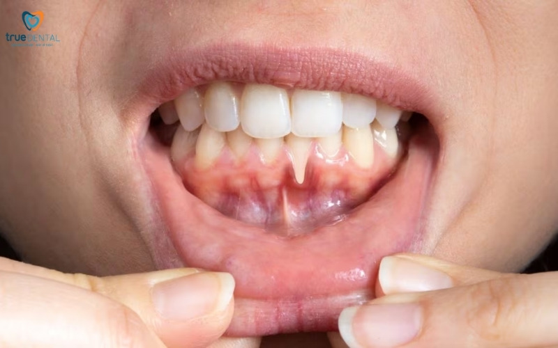 Những lý do khiến men răng bị mòn 4 men răng bị mòn