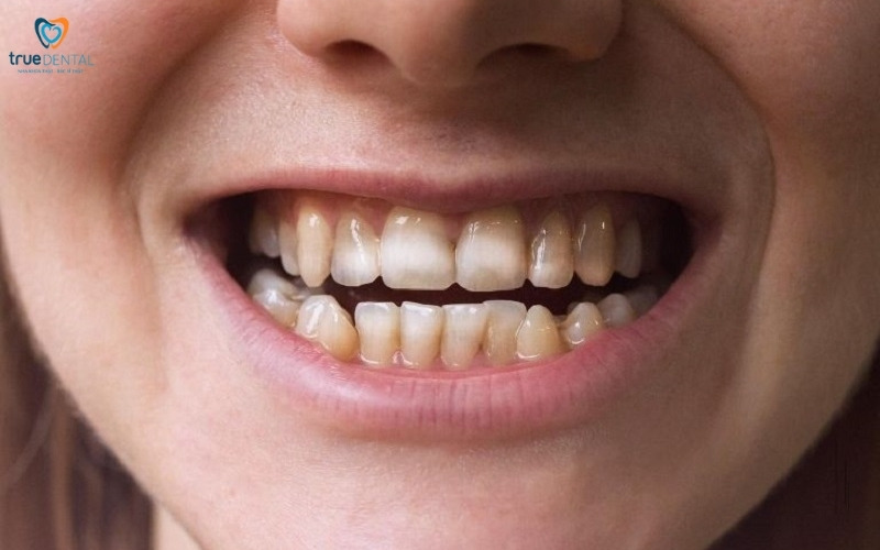 Những lý do khiến men răng bị mòn 2 men răng bị mòn