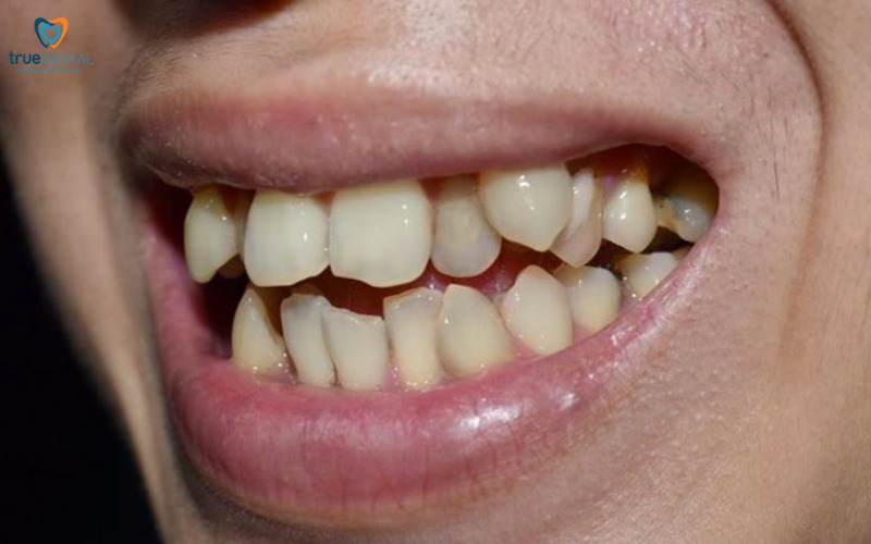 niềng răng invisalign cho răng khấp khểnh