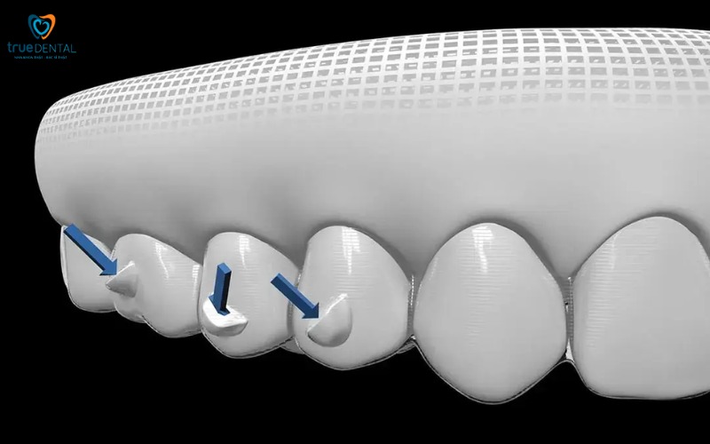 niềng răng invisalign cho răng khấp khểnh