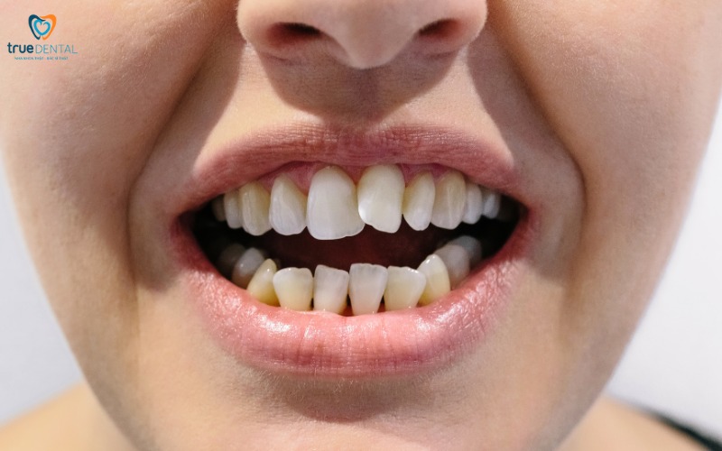 niềng răng invisalign cho răng khấp khểnh