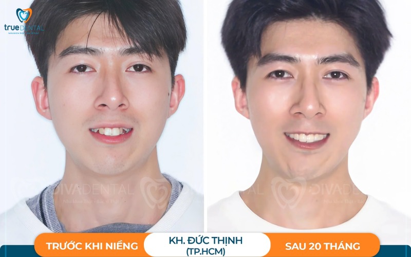niềng răng invisalign cho răng khấp khểnh
