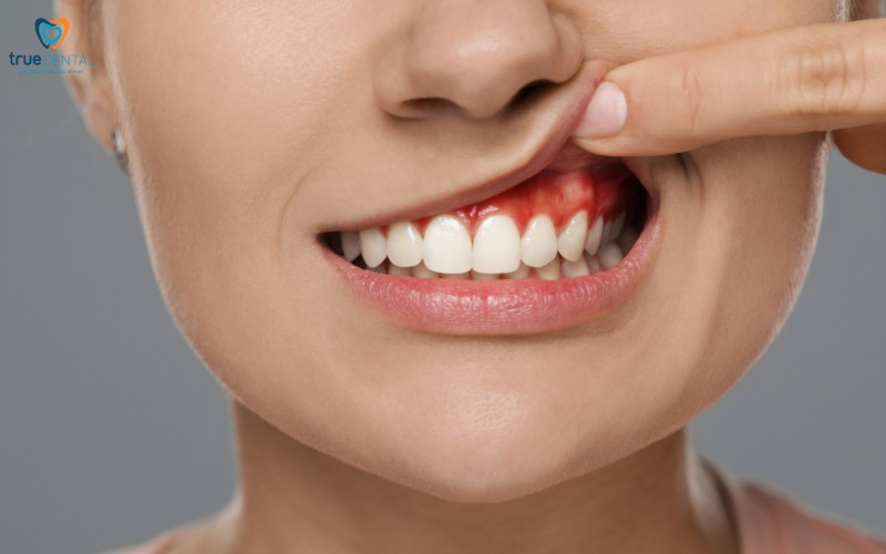 Rủi ro khi bọc răng sứ ở người bị viêm lợi