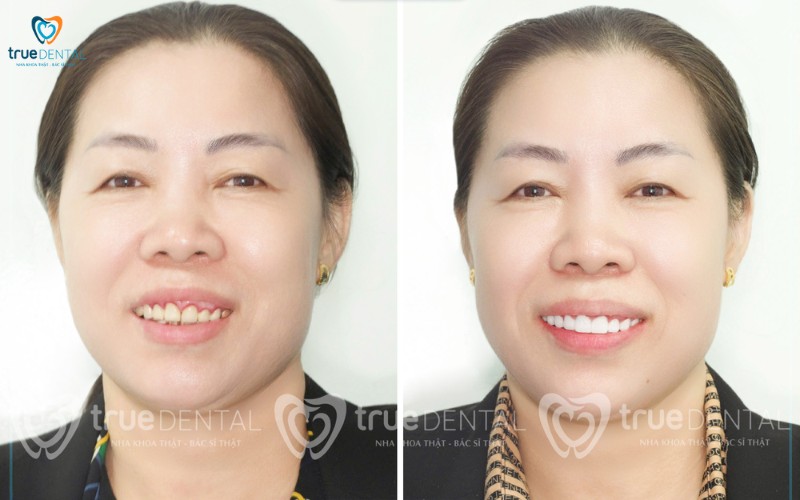 Rủi ro khi bọc răng sứ ở người bị viêm lợi