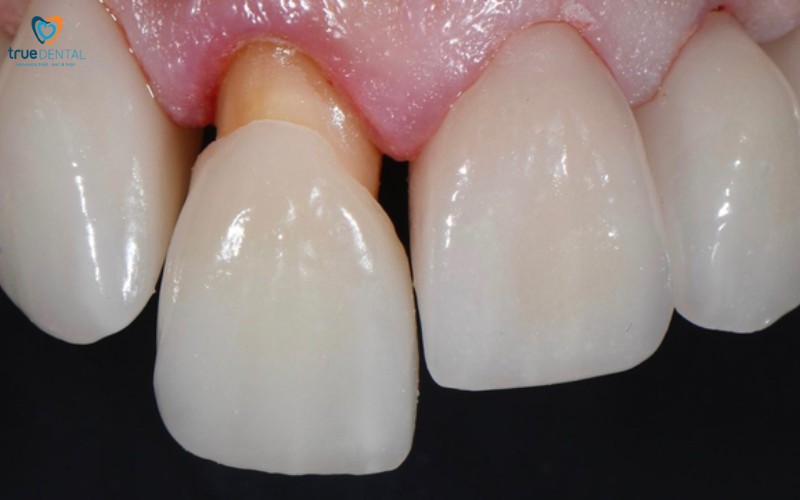 Rủi ro khi bọc răng sứ ở người bị viêm lợi