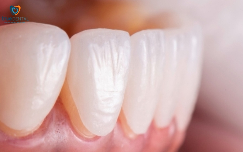 Rủi ro khi bọc răng sứ ở người bị viêm lợi