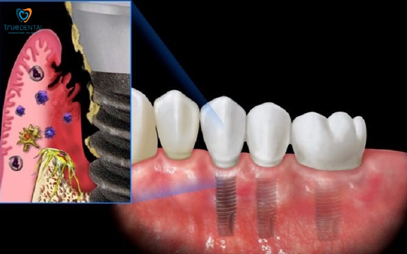 Rủi ro khi cấy ghép Implant ở người hút thuốc 2 Rủi ro khi cấy ghép Implant ở người hút thuốc
