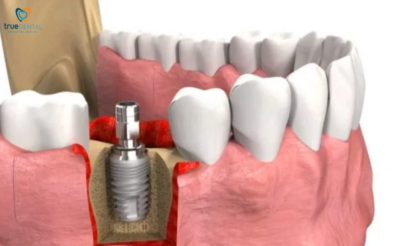 Rủi ro khi cấy ghép Implant ở người hút thuốc 3 rủi ro khi cấy ghép Implant ở người hút thuốc