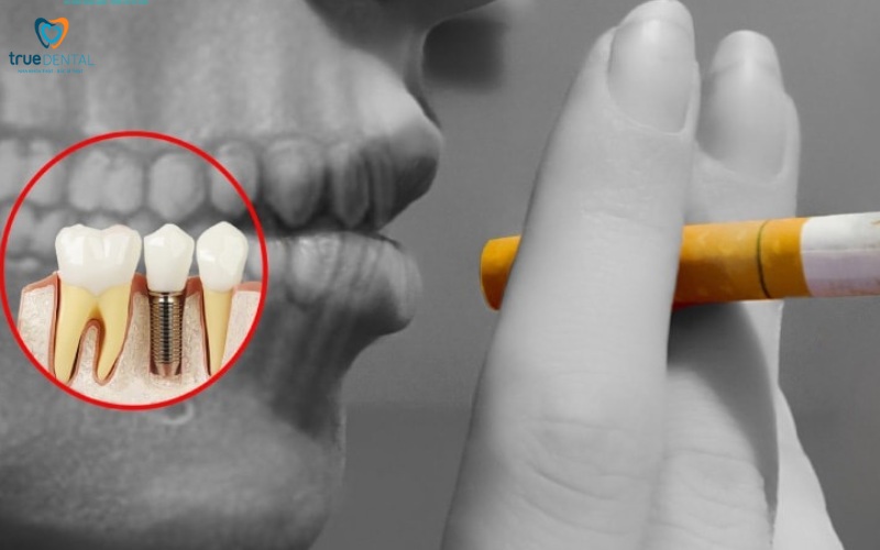 Rủi ro khi cấy ghép Implant ở người hút thuốc 4 rủi ro khi cấy ghép Implant ở người hút thuốc