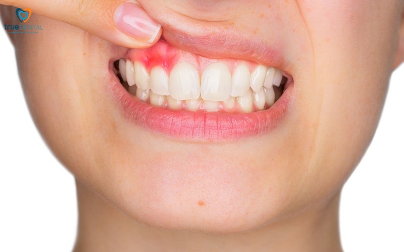 Rủi ro niềng răng ở người bị viêm lợi