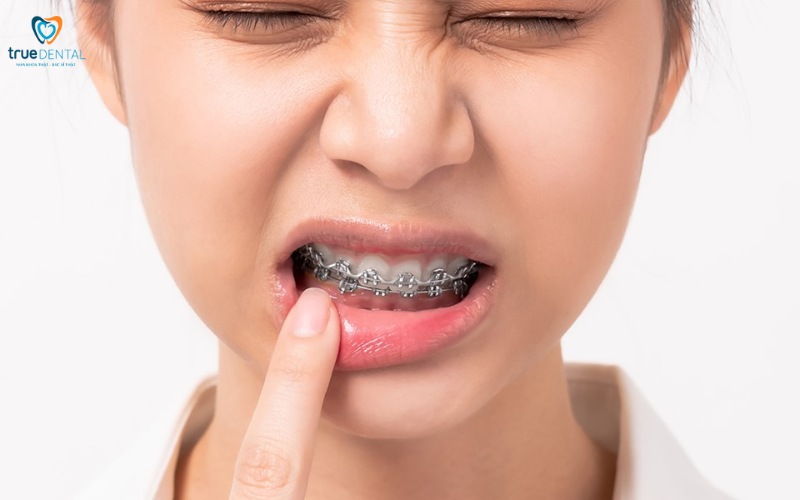 Rủi ro niềng răng ở người bị viêm lợi