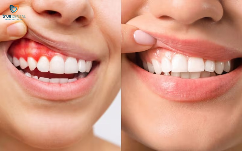 Rủi ro niềng răng ở người bị viêm lợi