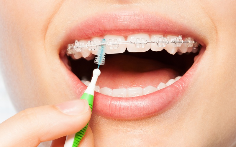 Rủi ro niềng răng ở người bị viêm lợi