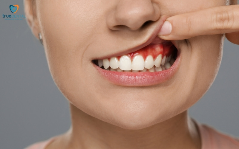 Rủi ro viêm nướu ở người hút thuốc thường xuyên 2 Rủi ro viêm nướu ở người hút thuốc