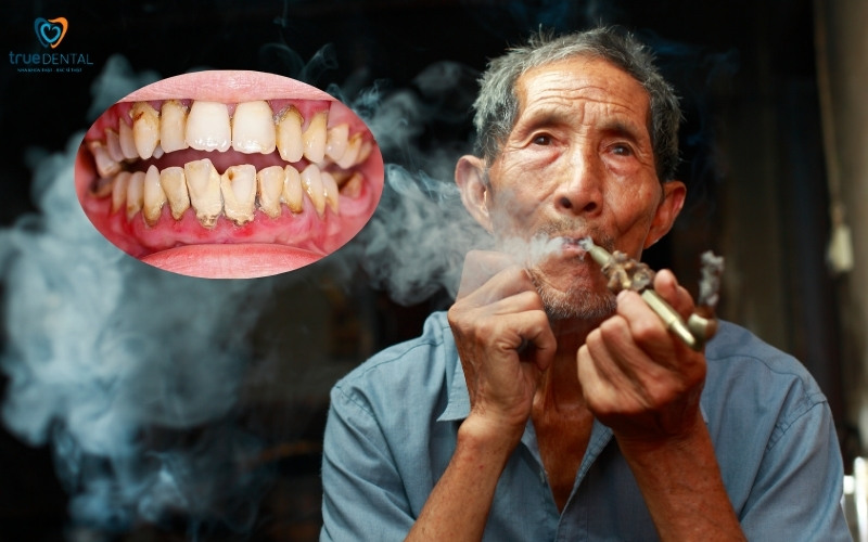 Rủi ro viêm nướu ở người hút thuốc thường xuyên 3 Rủi ro viêm nướu ở người hút thuốc