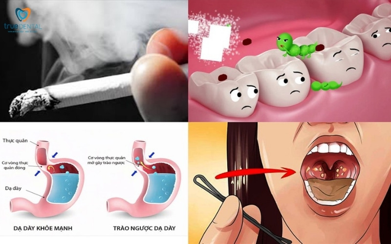 Rủi ro viêm nướu ở người hút thuốc thường xuyên 4 Rủi ro viêm nướu ở người hút thuốc