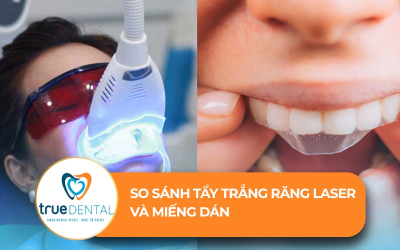 so sánh tẩy trắng răng laser và miếng dán