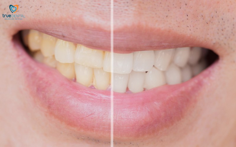 So sánh tẩy trắng răng laser và miếng dán 4 so sánh tẩy trắng răng laser và miếng dán