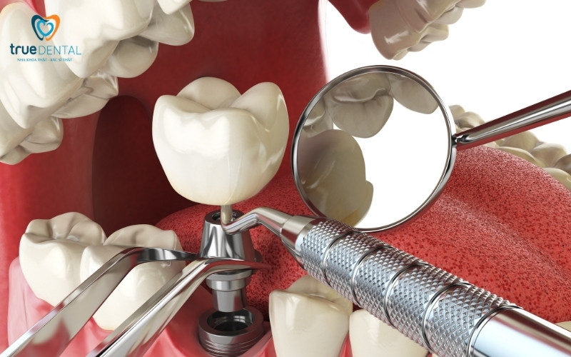 So sánh trụ implant Mỹ và Thụy Sĩ - Nên chọn loại nào? 1 so sánh trụ implant Mỹ và Thụy Sĩ