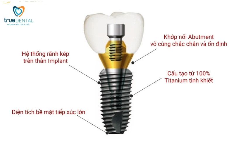 So sánh trụ implant Mỹ và Thụy Sĩ - Nên chọn loại nào? 2 so sánh trụ implant Mỹ và Thụy Sĩ