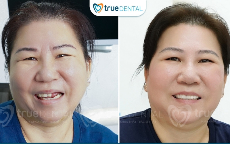 So sánh trụ implant Mỹ và Thụy Sĩ - Nên chọn loại nào? 4 so sánh trụ implant Mỹ và Thụy Sĩ