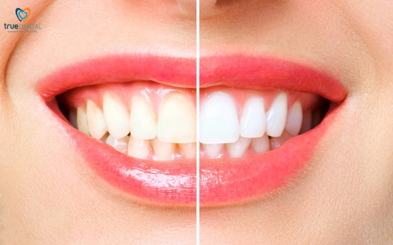 Tẩy trắng răng tại nhà an toàn và hiệu quả 2 tẩy trắng răng tại nhà an toàn
