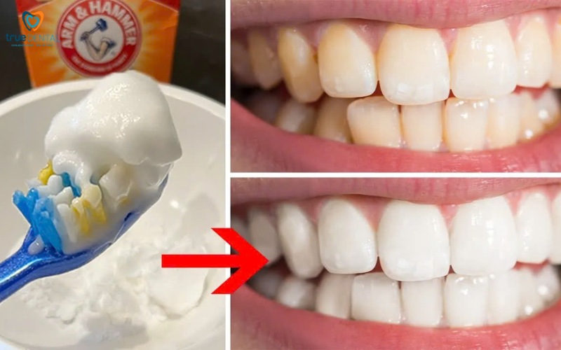 Tẩy trắng răng tại nhà an toàn và hiệu quả 5 tẩy trắng răng tại nhà an toàn