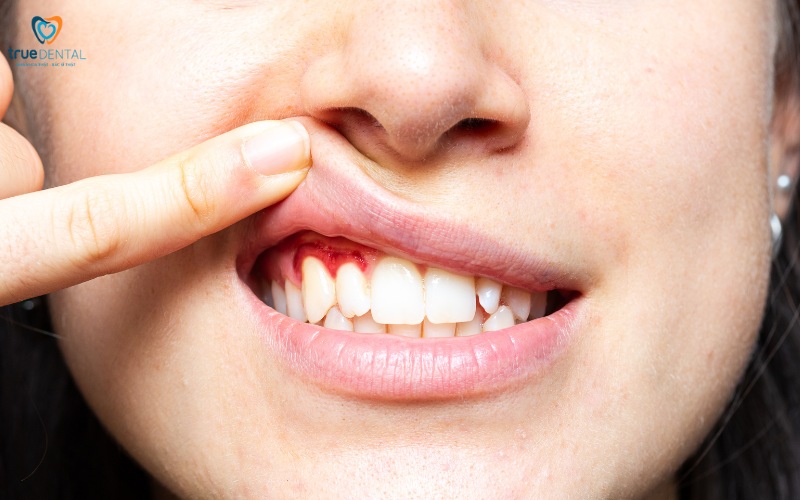 Tẩy trắng răng tại nhà an toàn và hiệu quả 7 tẩy trắng răng tại nhà an toàn