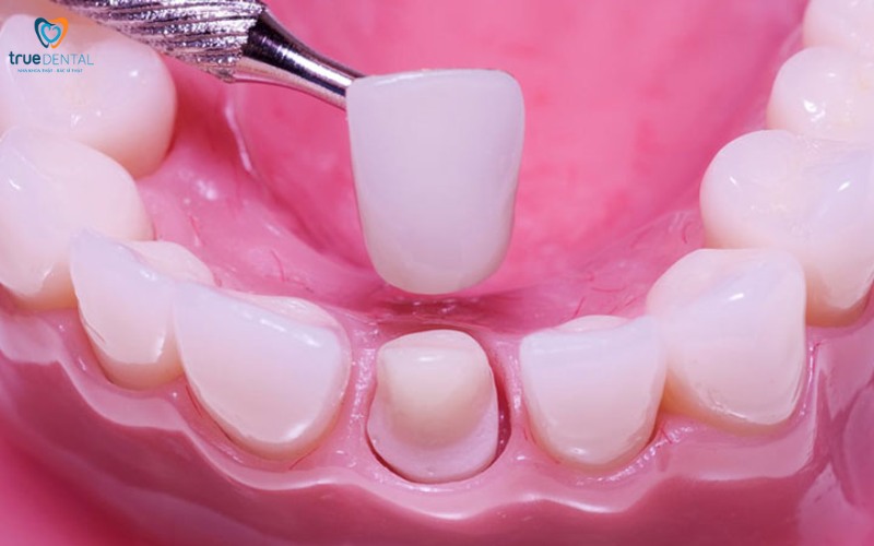 Thời gian hồi phục sau khi bọc răng sứ