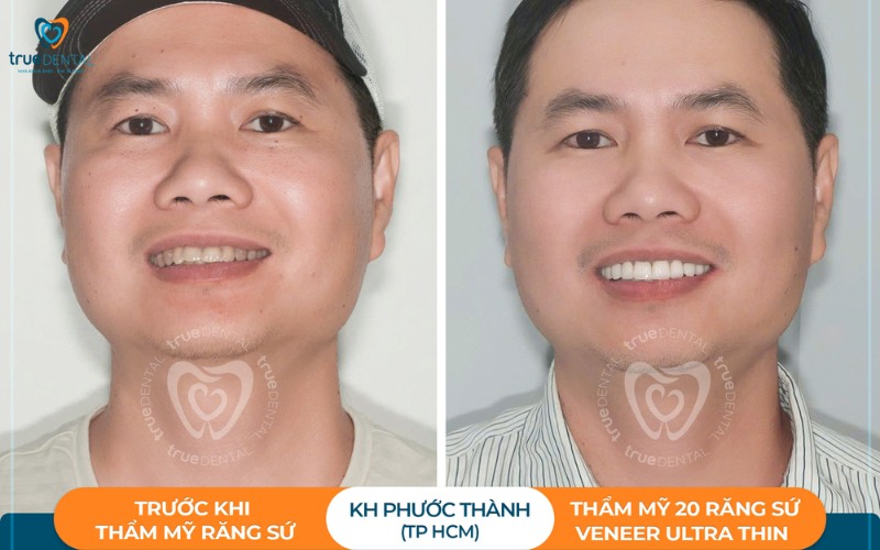 Thời gian hồi phục sau khi bọc răng sứ