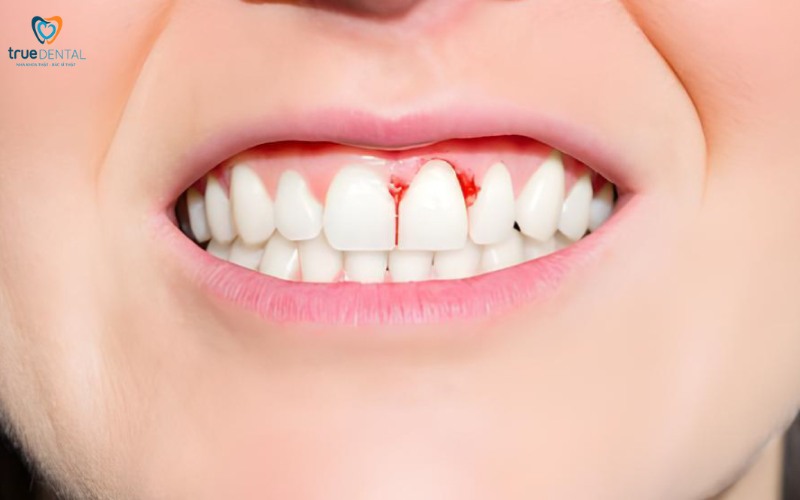 Thời gian hồi phục sau khi bọc răng sứ