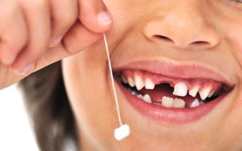 Thời gian hồi phục sau khi nhổ răng sữa cho bé 7 Thời gian hồi phục sau khi nhổ răng sữa cho trẻ