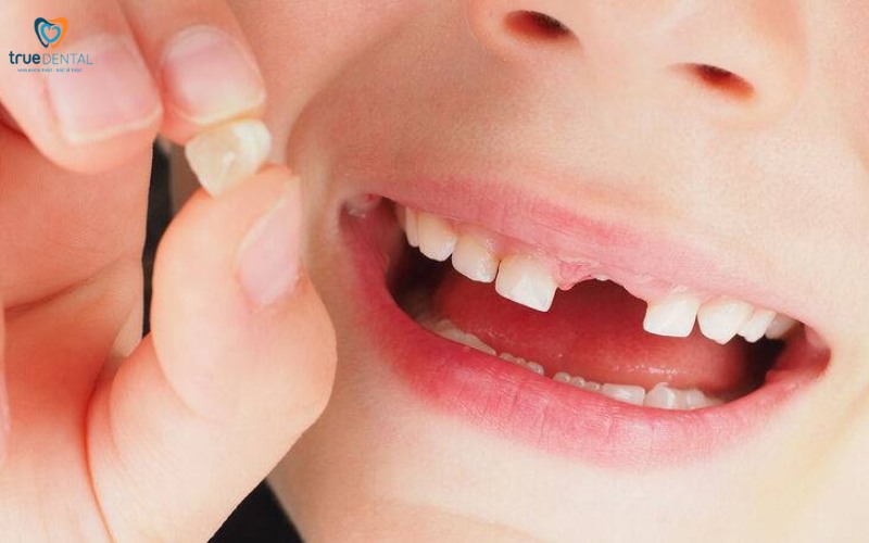 Thời gian hồi phục sau khi nhổ răng sữa cho bé 2 Thời gian hồi phục sau khi nhổ răng sữa cho trẻ