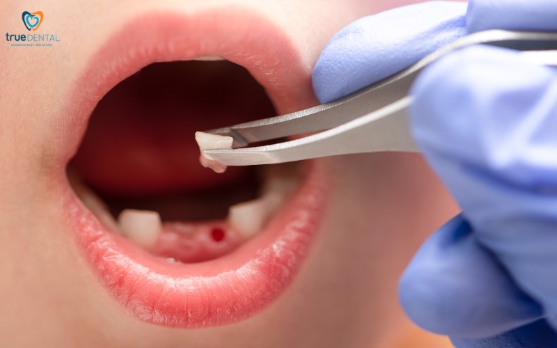 Thời gian hồi phục sau khi nhổ răng sữa cho bé 8 Thời gian hồi phục sau khi nhổ răng sữa cho trẻ