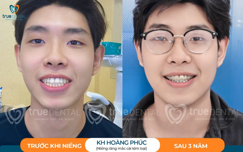 Thời gian niềng răng cho trường hợp răng hô nhẹ