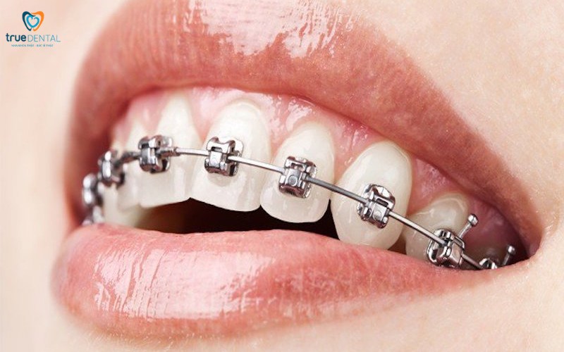 Thời gian niềng răng cho trường hợp răng hô nhẹ