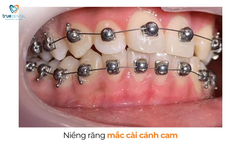 Thời gian niềng răng cho trường hợp răng hô nhẹ