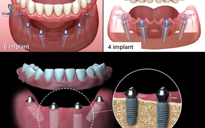 Thời gian hồi phục sau cấy ghép implant toàn hàm 1 Thời gian hồi phục sau cấy ghép implant toàn hàm